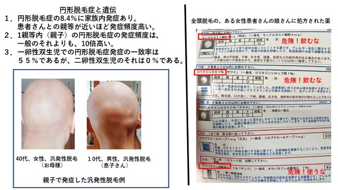 円形脱毛症　病院